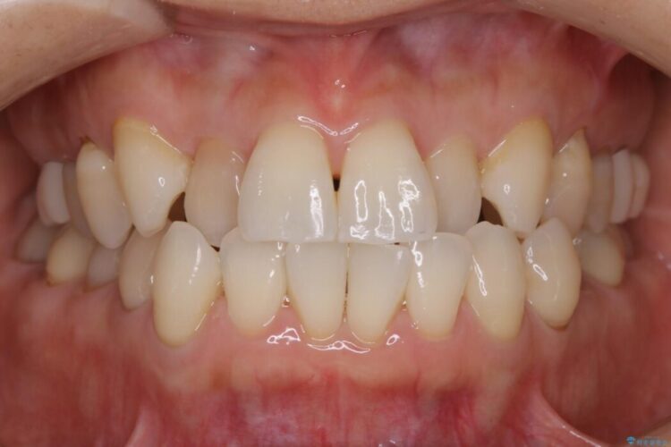 【30代女性】前歯の反対咬合をマウスピースで改善 治療途中画像