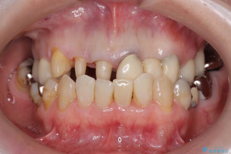 【40代女性】前歯のかぶせ物をセラミックでやりなおす 治療途中画像