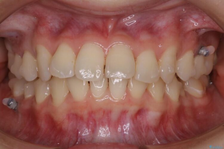 【20代女性】ブライダルに向けた矯正できれいなスマイルラインへ 治療途中画像