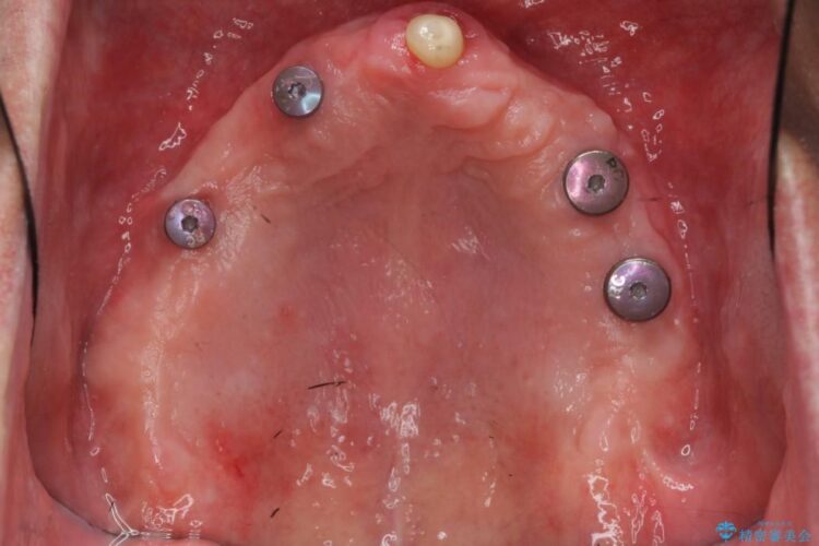 【50代男性】重度の歯周病をインプラントを用いた上顎義歯（入れ歯）で補綴治療 治療途中画像