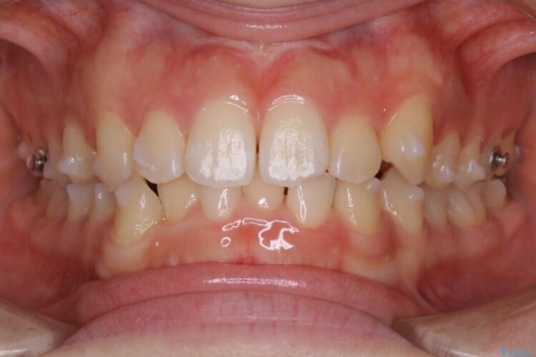 【10代女性】すきっ歯（正中離開）のインビザライン治療 治療途中画像