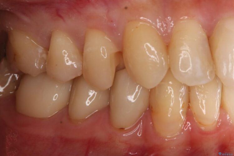 【20代 女性】劣化した保険のプラスチックをセラミックへ 治療途中画像