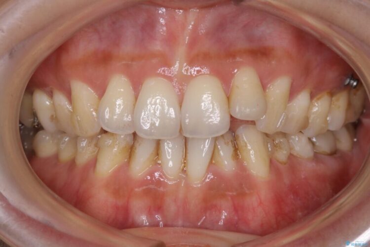 【30代女性】非抜歯で噛み合わせとガタつきの改善 治療途中画像