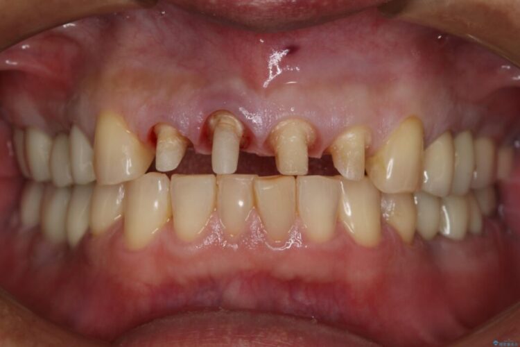 【50代男性】前歯の被せ物を新しく 治療途中画像