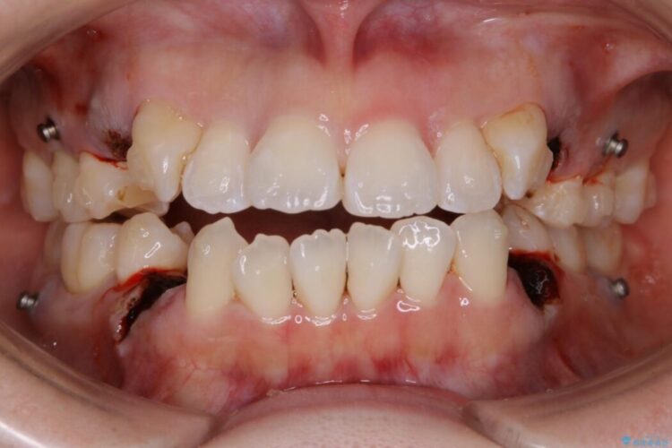 【30代女性】インビザラインで抜歯矯正 治療途中画像