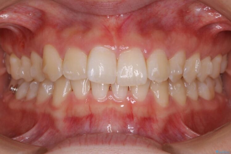 【20代女性】噛み合わせのズレからくるガタついた歯列をインビザライン矯正治療 治療途中画像