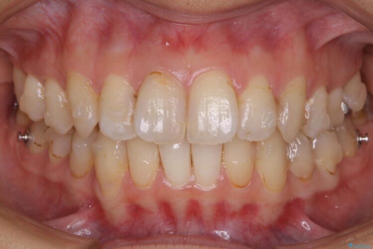 【20代女性】非抜歯で歯列をコンパクトに 治療途中画像