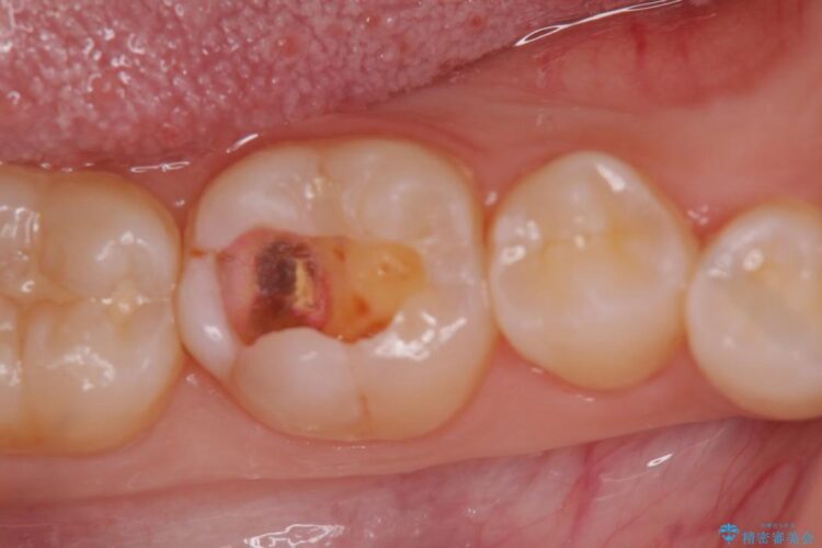 【20代女性】黒ずんだ虫歯をとり白い歯へ 治療途中画像