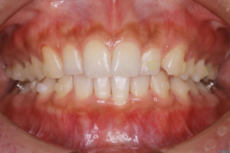 【20代女性】ゴムかけを併用し噛み合わせを改善!インビザライン矯正 治療途中画像