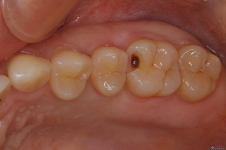 【30代女性】黒ずんだ虫歯をセラミック治療 治療途中画像