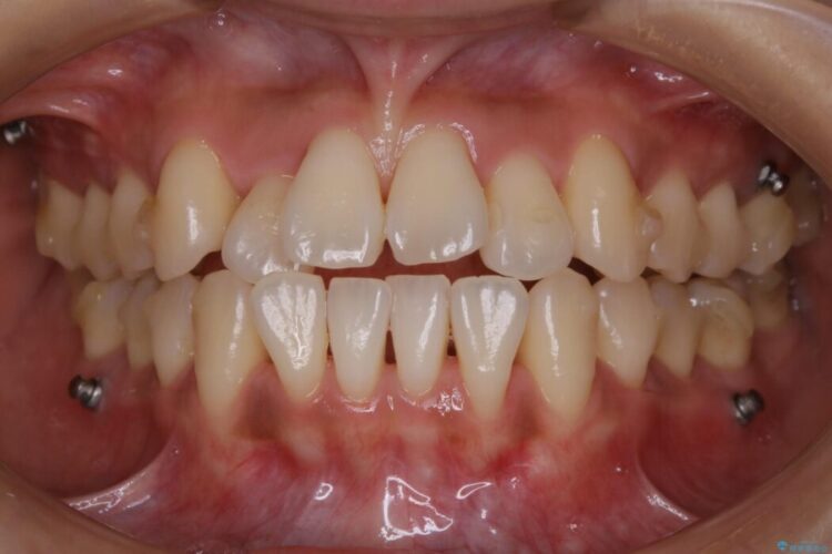 【20代女性】抜歯無しで前歯のがたがたを改善する 治療途中画像