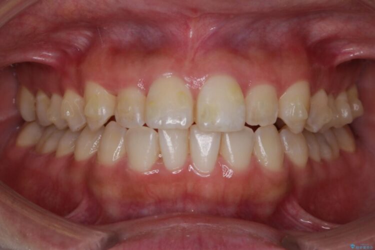 【20代女性】軽度の反対咬合を部分矯正でなおす 治療途中画像