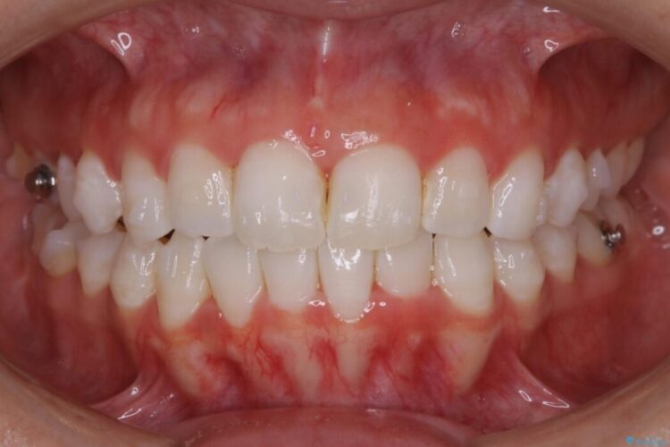 【20代女性】歯軸傾斜を改善して噛み合わせを正しくする 治療途中画像