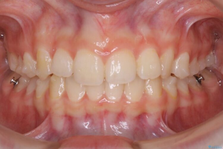 【10代女性】歯並びを整えて自信が持てる素敵な笑顔に 治療途中画像