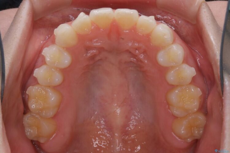 【20代女性】短期間でのインビザライン治療で見た目の悩みを改善する 治療途中画像