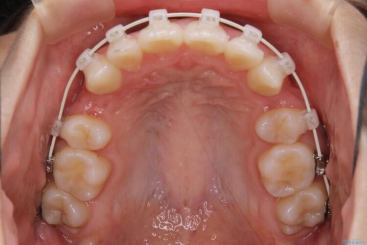 【20代女性】抜歯矯正で出っ張った口元を改善する 治療途中画像