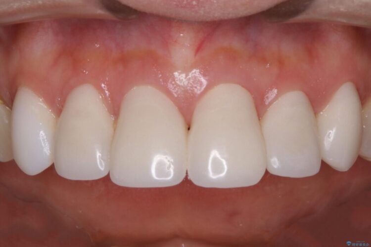 【30代女性】前歯の見た目をセラミッククラウンで変える 治療途中画像