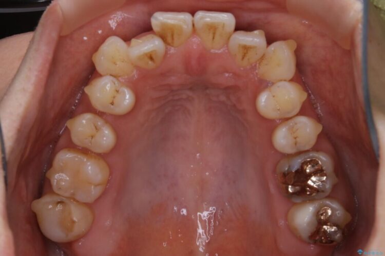 【20代女性】開咬の隙間と歯列の凸凹をまとめて改善する 治療途中画像
