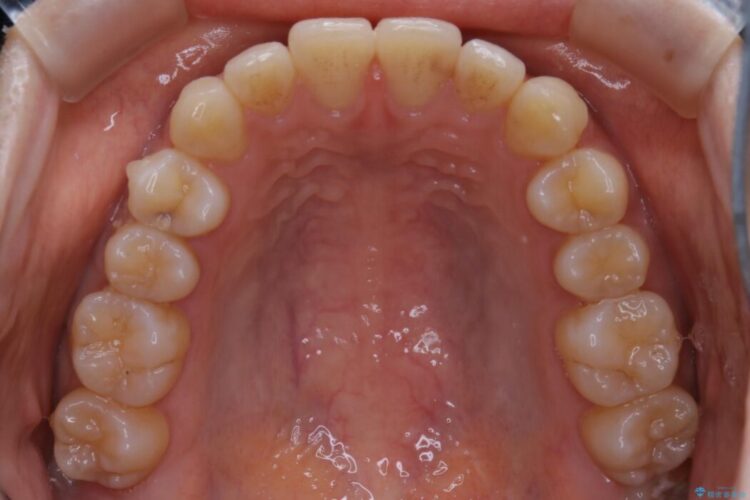 【20代女性】気になる部分だけをマウスピース矯正 治療途中画像
