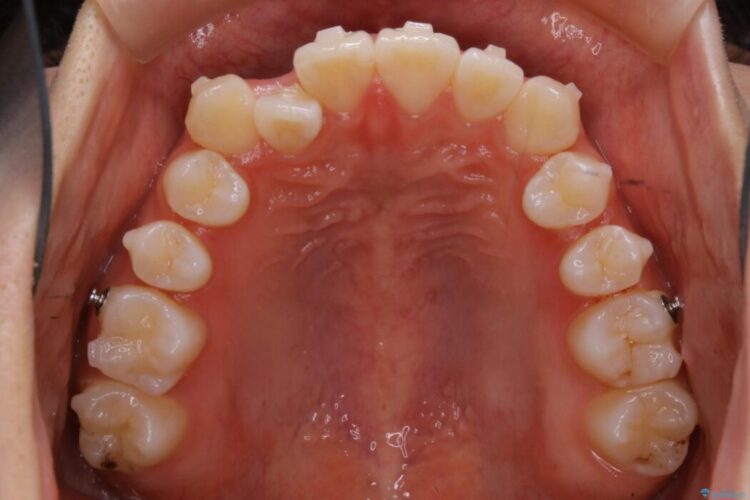 【10代女性】早めに始める受け口（反対咬合）の矯正治療 治療途中画像