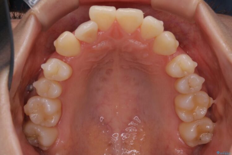 【20代女性】非抜歯でもガタガタを改善するインビザライン矯正 治療途中画像