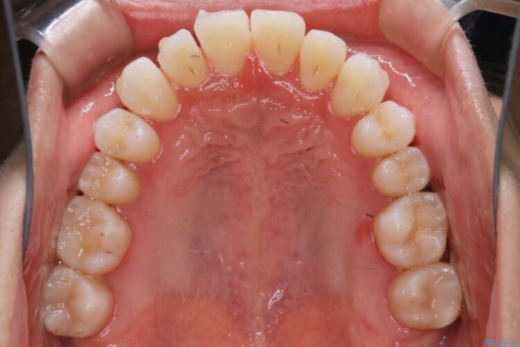 【20代男性】上顎のガタガタな歯列をインビザラインで矯正治療 治療途中画像