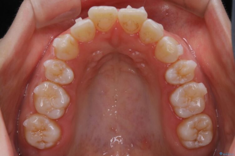 【20代女性】前歯が噛み合わない!開咬（オープンバイト）の矯正治療 治療途中画像