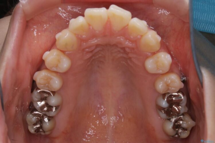 【20代女性】非抜歯でマウスピースの限界に挑戦する矯正治療 治療途中画像