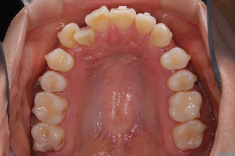 【20代女性】隠れた前歯とガタつきをきれいな歯列弓へ 治療途中画像