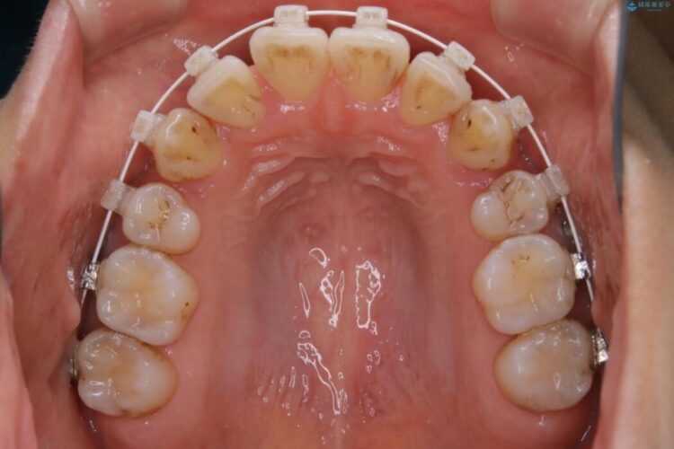 【20代女性】抜歯ワイヤー矯正で八重歯がスッキリ 治療途中画像