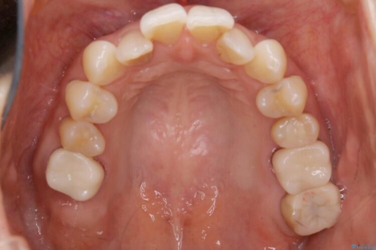 【30代女性】前歯の反対咬合をマウスピースで改善 治療途中画像