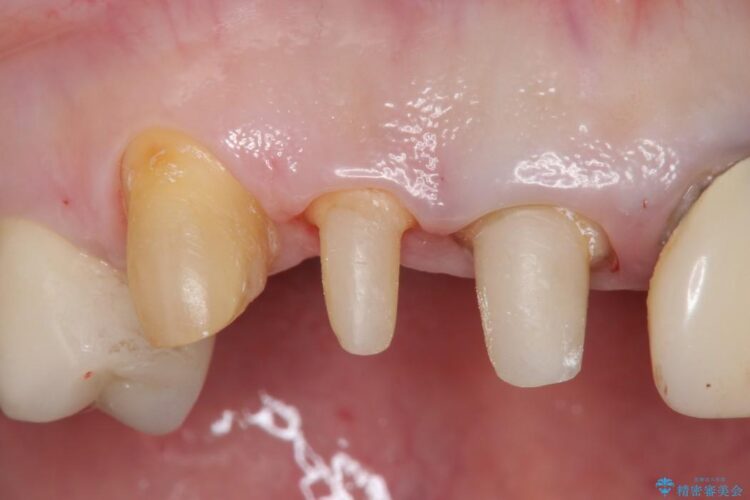 【40代女性】前歯のかぶせ物をセラミックでやりなおす 治療途中画像