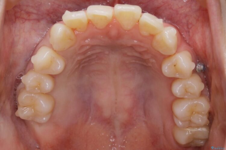 【20代女性】ブライダルに向けた矯正できれいなスマイルラインへ 治療途中画像