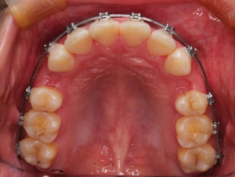 【20代女性】出っ歯の矯正 治療例 治療途中画像