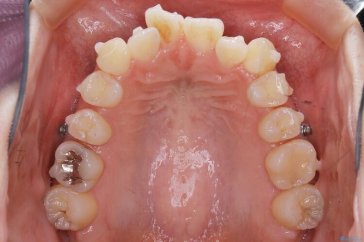 【20代女性】前歯の真ん中（正中）のズレとガタつきを効率よく矯正する 治療途中画像