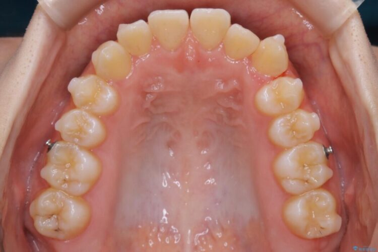 【10代女性】すきっ歯（正中離開）のインビザライン治療 治療途中画像