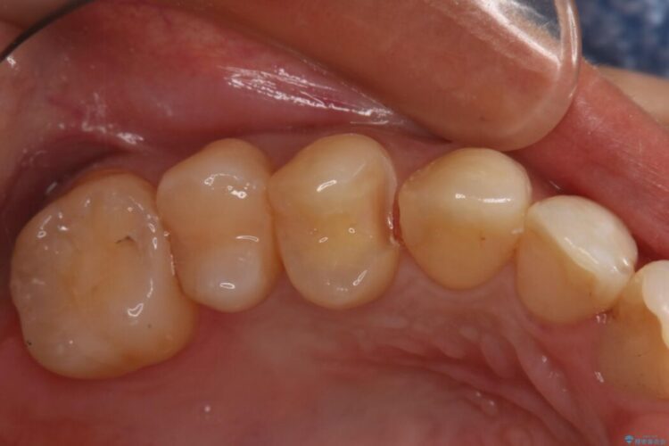 【20代 女性】劣化した保険のプラスチックをセラミックへ 治療途中画像