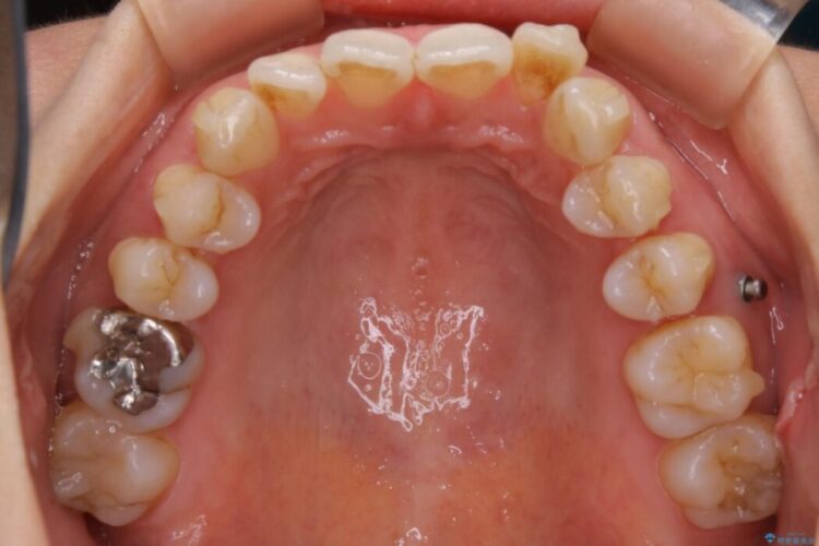 【30代女性】非抜歯で噛み合わせとガタつきの改善 治療途中画像
