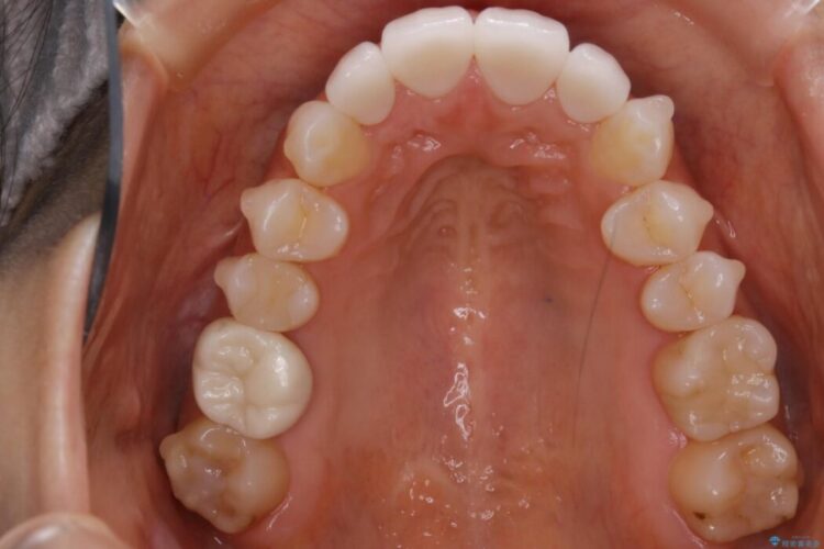 【30代女性】噛み合わせのズレを解消する 治療途中画像