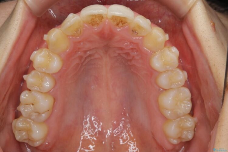 【20代女性】噛み合わせの歪みを超短期間でインビザライン治療 治療途中画像