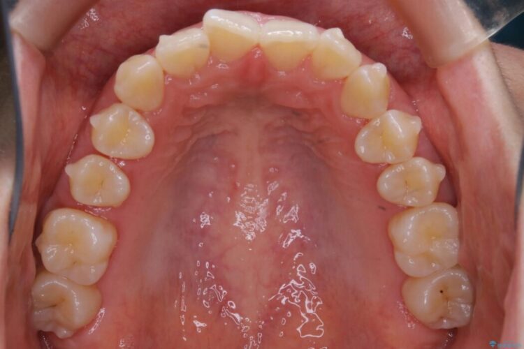 【20代女性】噛み合わせのズレからくるガタついた歯列をインビザライン矯正治療 治療途中画像