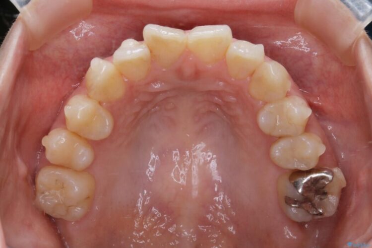 【20代女性】非抜歯で歯列をコンパクトに 治療途中画像