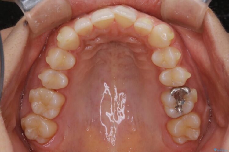 【20代女性】ゴムかけを併用し噛み合わせを改善!インビザライン矯正 治療途中画像