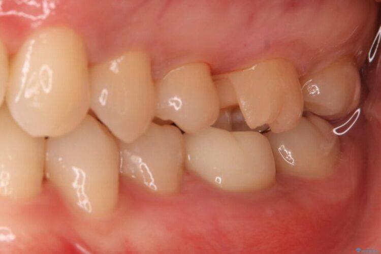 【30代女性】黒ずんだ虫歯をセラミック治療 治療途中画像