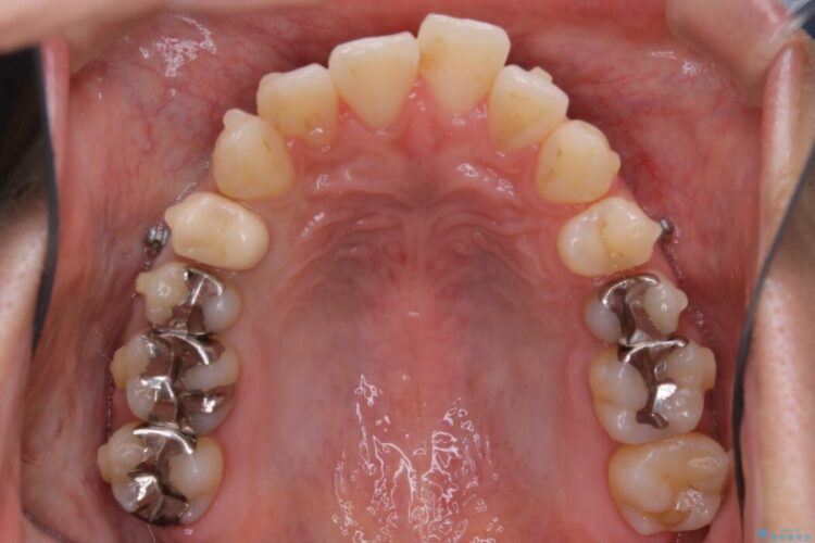 【20代男性】出っ歯をインビザラインで矯正治療 治療途中画像