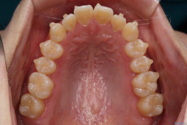 【20代女性】軽度の反対咬合を部分矯正でなおす 治療途中画像