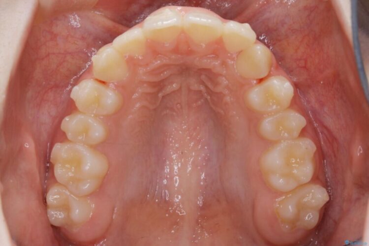 【10代女性】歯並びを整えて自信が持てる素敵な笑顔に 治療途中画像