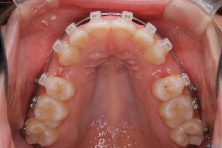 【20代女性】口元を引っ込めたい Eラインの改善 治療途中画像