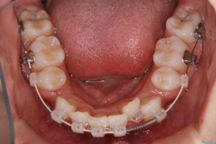 【20代女性】抜歯矯正で出っ張った口元を改善する 治療途中画像