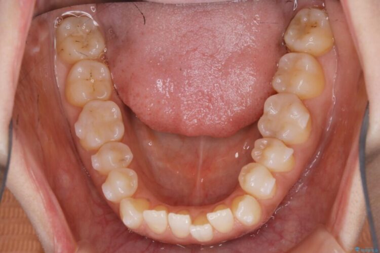 【30代女性】短期間で非抜歯による反対咬合(受け口)の改善 治療途中画像